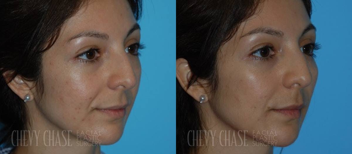 Dermal Fillers Before & After Gallery - Patient 106387537 - Image 1