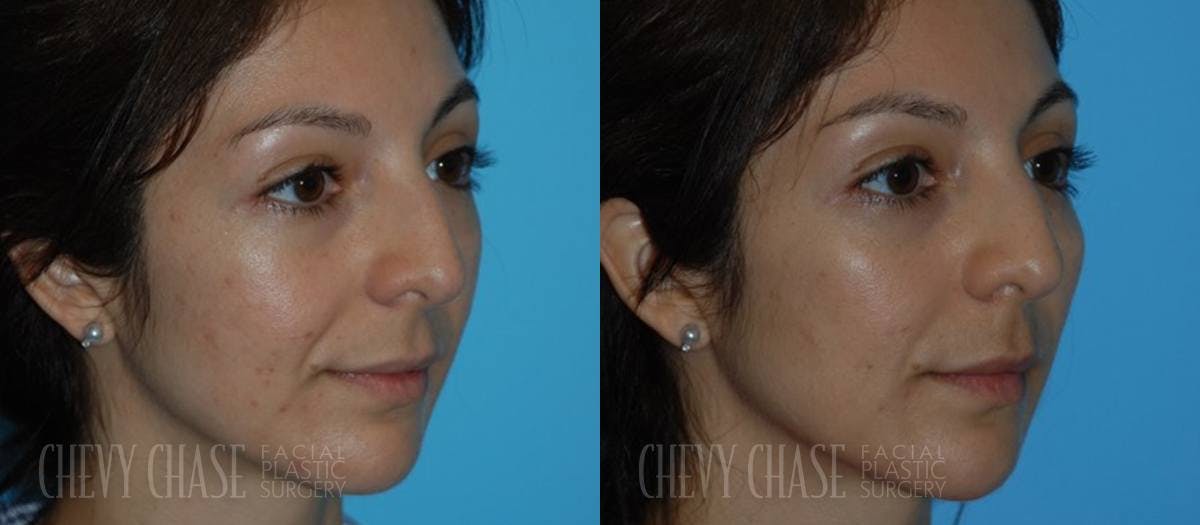Dermal Fillers Before & After Gallery - Patient 106387537 - Image 1