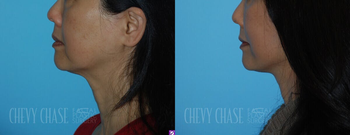 Facelift And Necklift Before & After Gallery - Patient 106387539 - Image 4