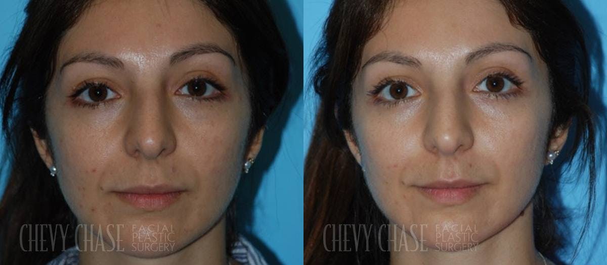 Dermal Fillers Before & After Gallery - Patient 106387537 - Image 2