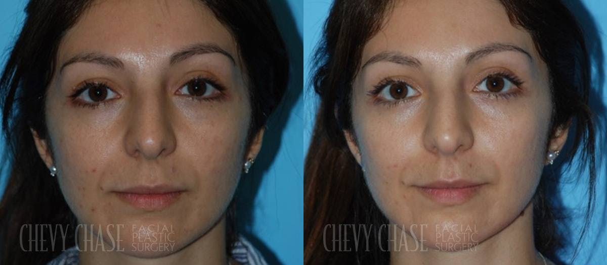 Dermal Fillers Before & After Gallery - Patient 106387537 - Image 2