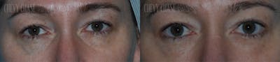Morpheus8 Before & After Gallery - Patient 106387538 - Image 1