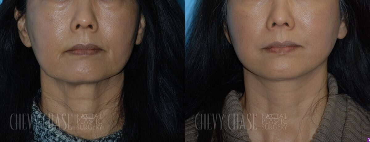 Facelift And Necklift Before & After Gallery - Patient 106387539 - Image 5