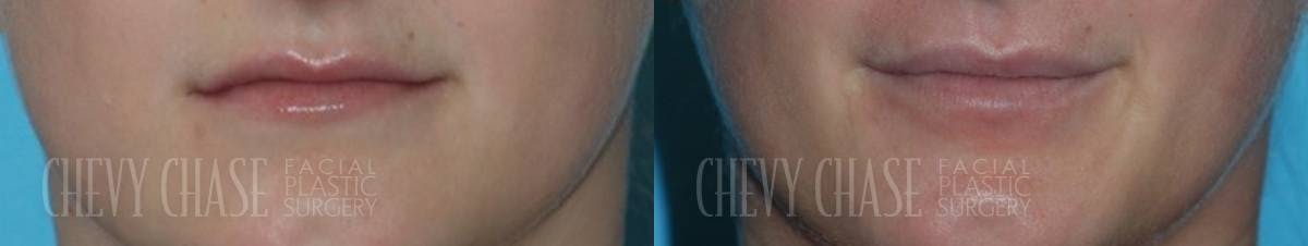 Dermal Fillers Before & After Gallery - Patient 106387541 - Image 1
