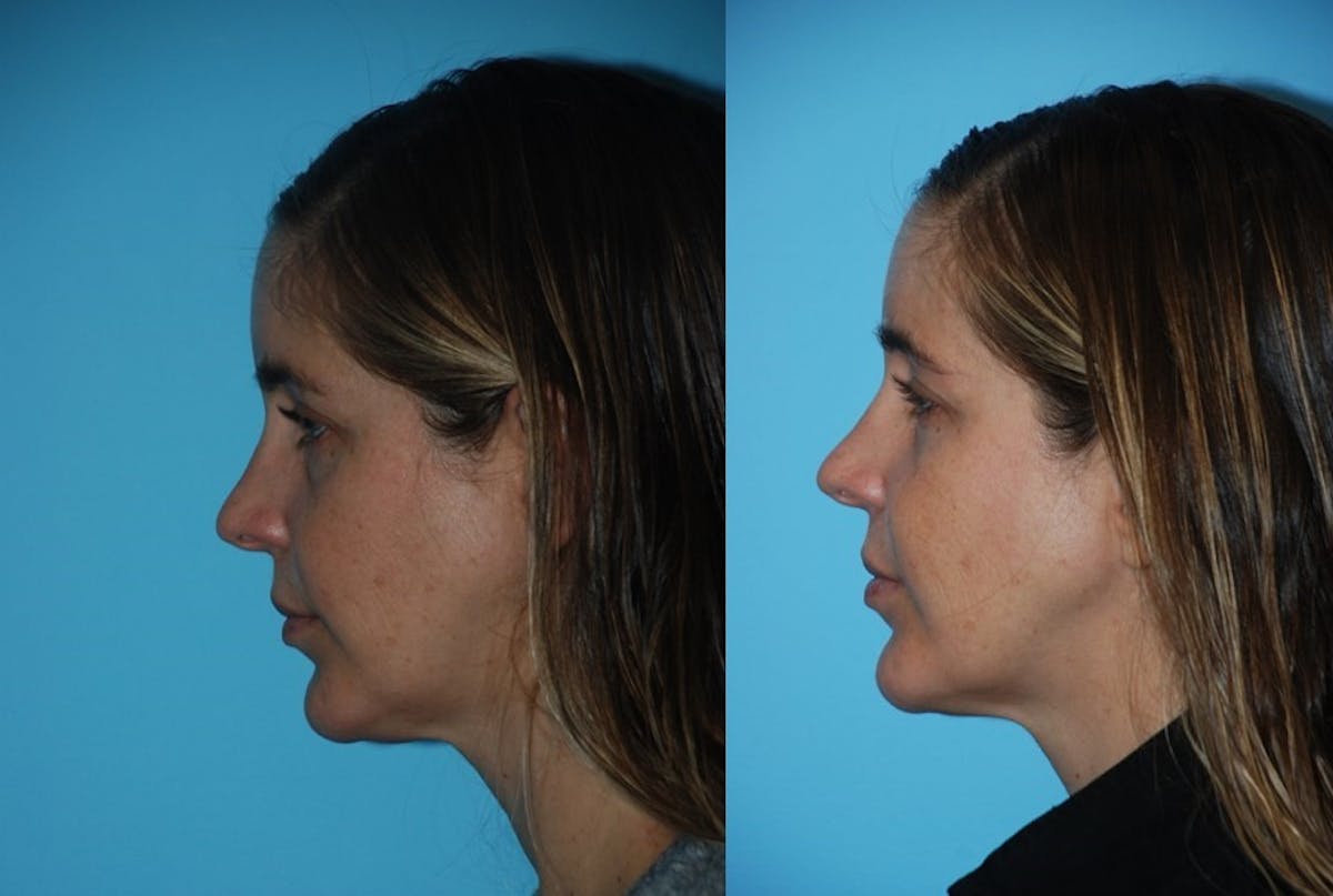 Morpheus8 Before & After Gallery - Patient 106387544 - Image 1