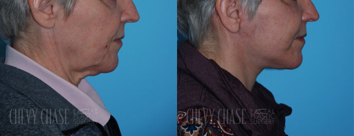 Facelift And Necklift Before & After Gallery - Patient 106387543 - Image 1