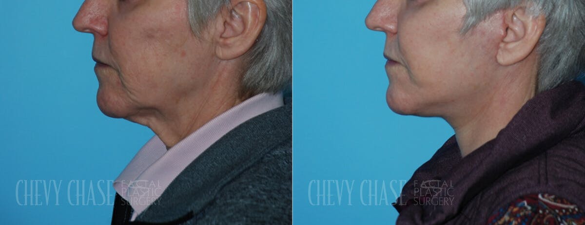 Facelift And Necklift Before & After Gallery - Patient 106387543 - Image 2