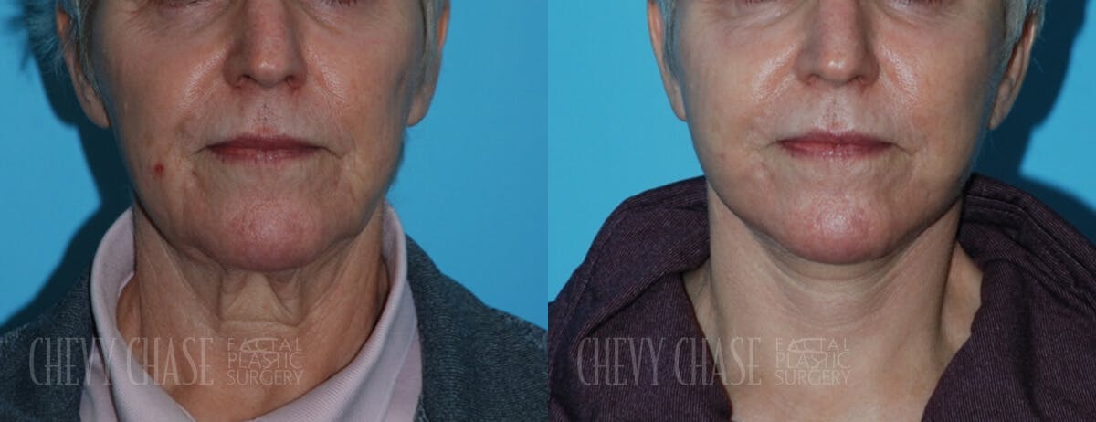 Facelift And Necklift Before & After Gallery - Patient 106387543 - Image 3
