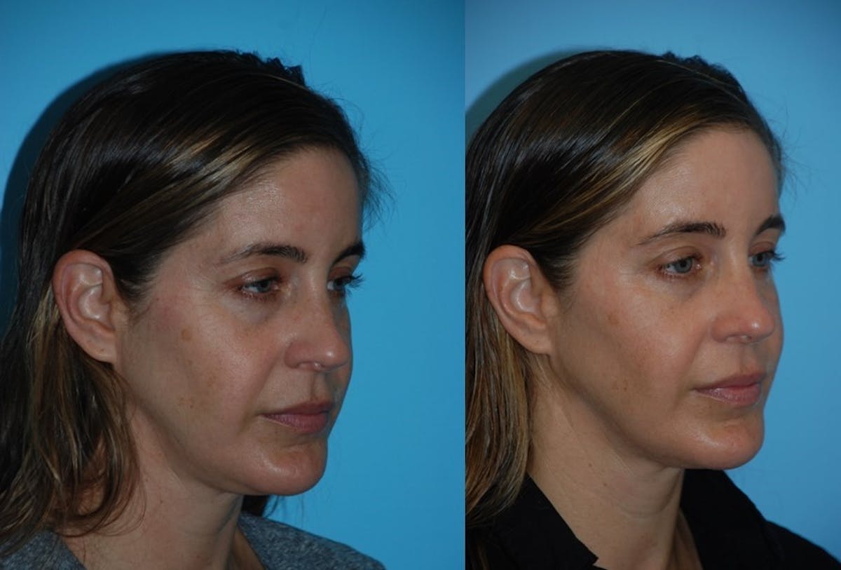 Morpheus8 Before & After Gallery - Patient 106387544 - Image 4
