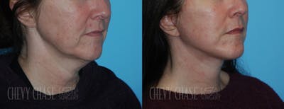 Facelift And Necklift Before & After Gallery - Patient 106387563 - Image 1