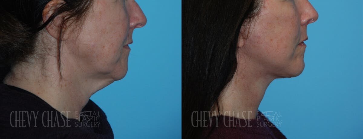 Facelift And Necklift Before & After Gallery - Patient 106387563 - Image 2