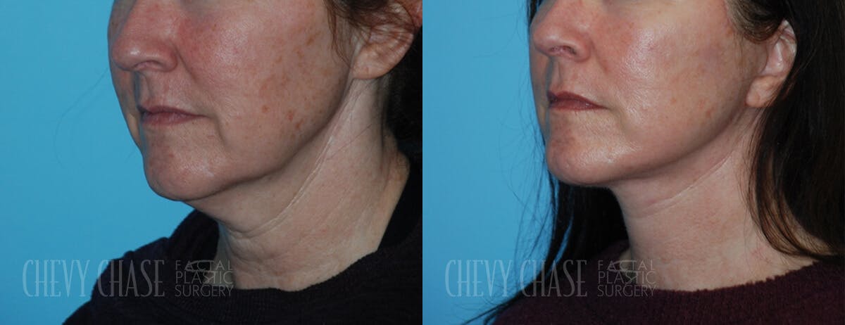 Facelift And Necklift Before & After Gallery - Patient 106387563 - Image 3