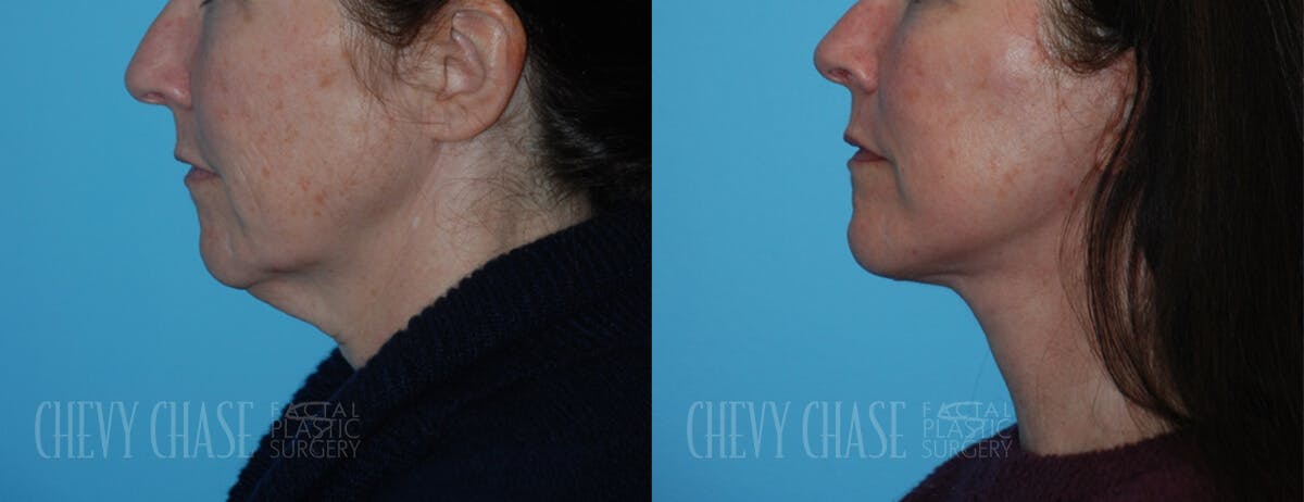 Facelift And Necklift Before & After Gallery - Patient 106387563 - Image 4