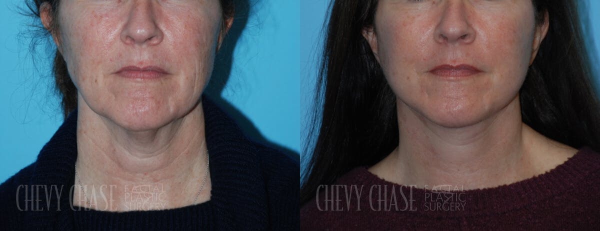 Facelift And Necklift Before & After Gallery - Patient 106387563 - Image 5