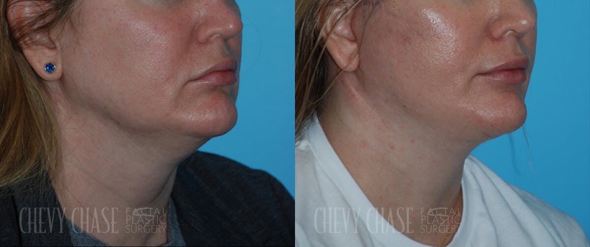 Facelift And Necklift Before & After Gallery - Patient 106387565 - Image 1