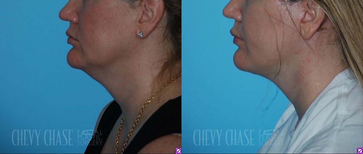 Facelift And Necklift Before & After Gallery - Patient 106387565 - Image 2