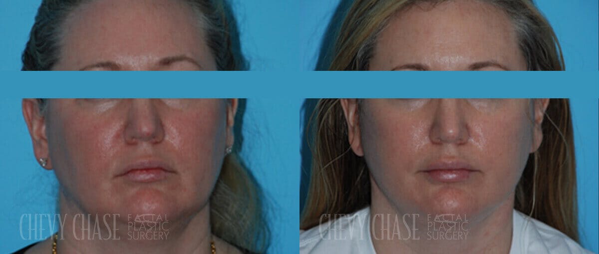Facelift And Necklift Before & After Gallery - Patient 106387565 - Image 3