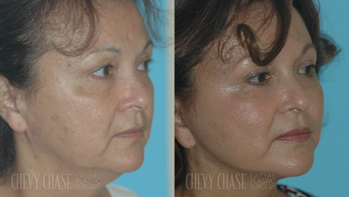 Facelift And Necklift Before & After Gallery - Patient 106387567 - Image 1