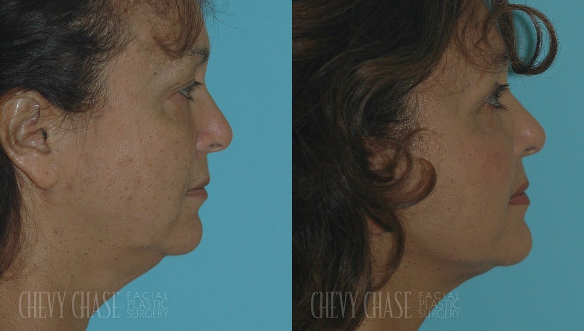 Facelift And Necklift Before & After Gallery - Patient 106387567 - Image 2