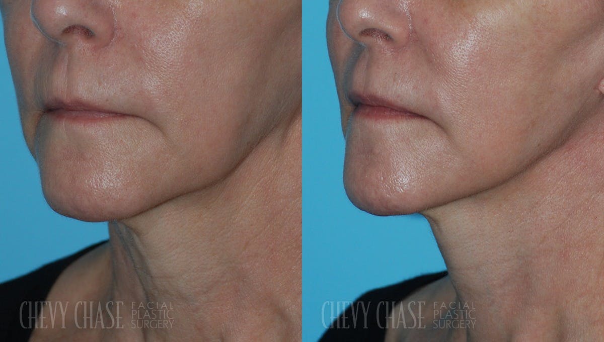 Facelift And Necklift Before & After Gallery - Patient 106387571 - Image 1