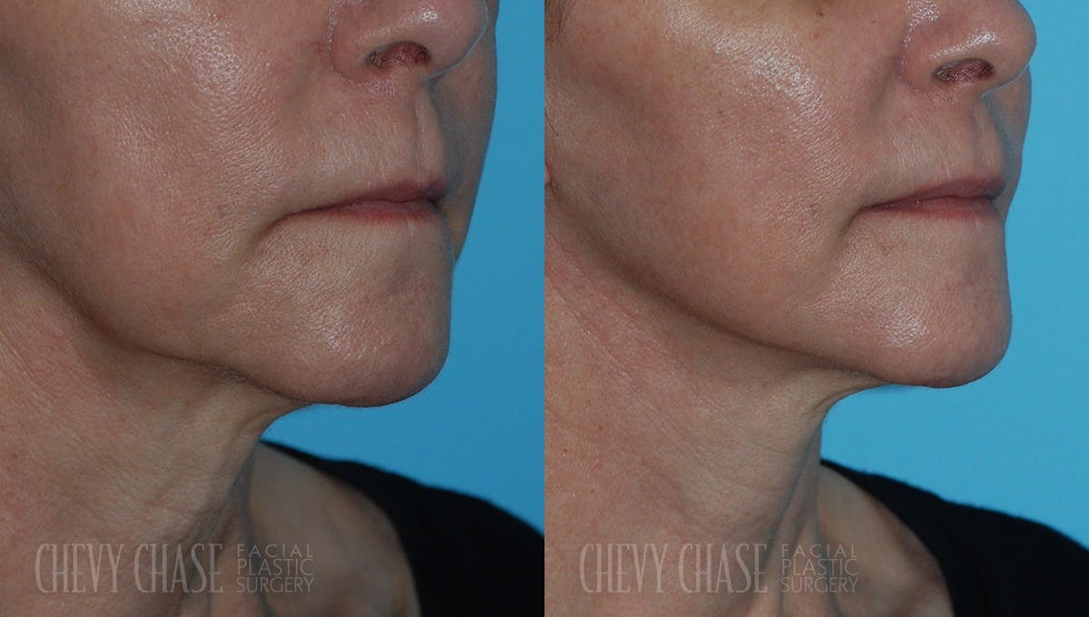 Facelift And Necklift Before & After Gallery - Patient 106387571 - Image 2