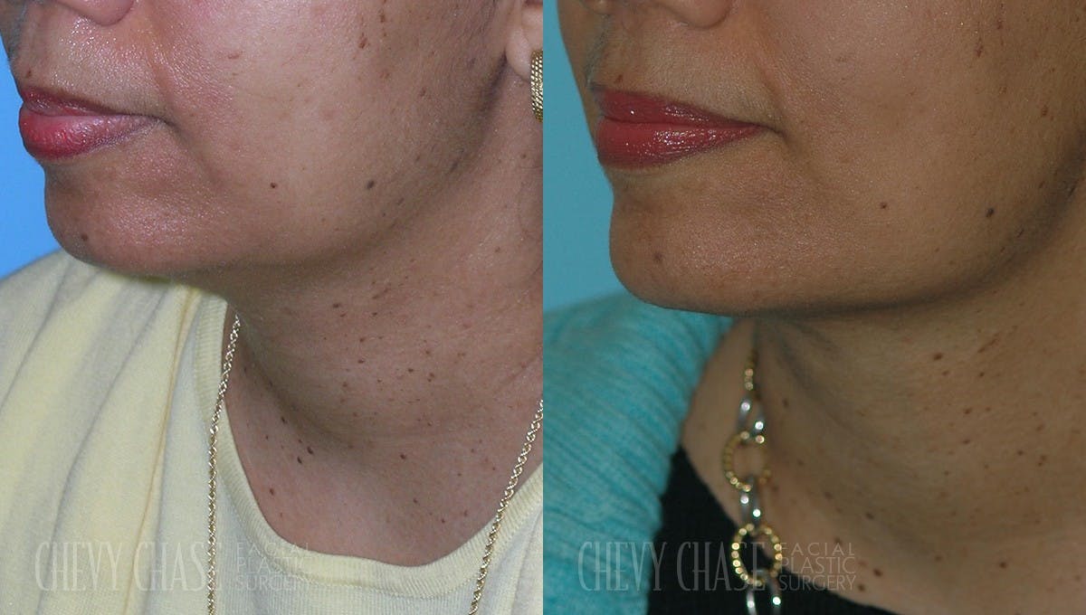 Facelift And Necklift Before & After Gallery - Patient 106387572 - Image 1