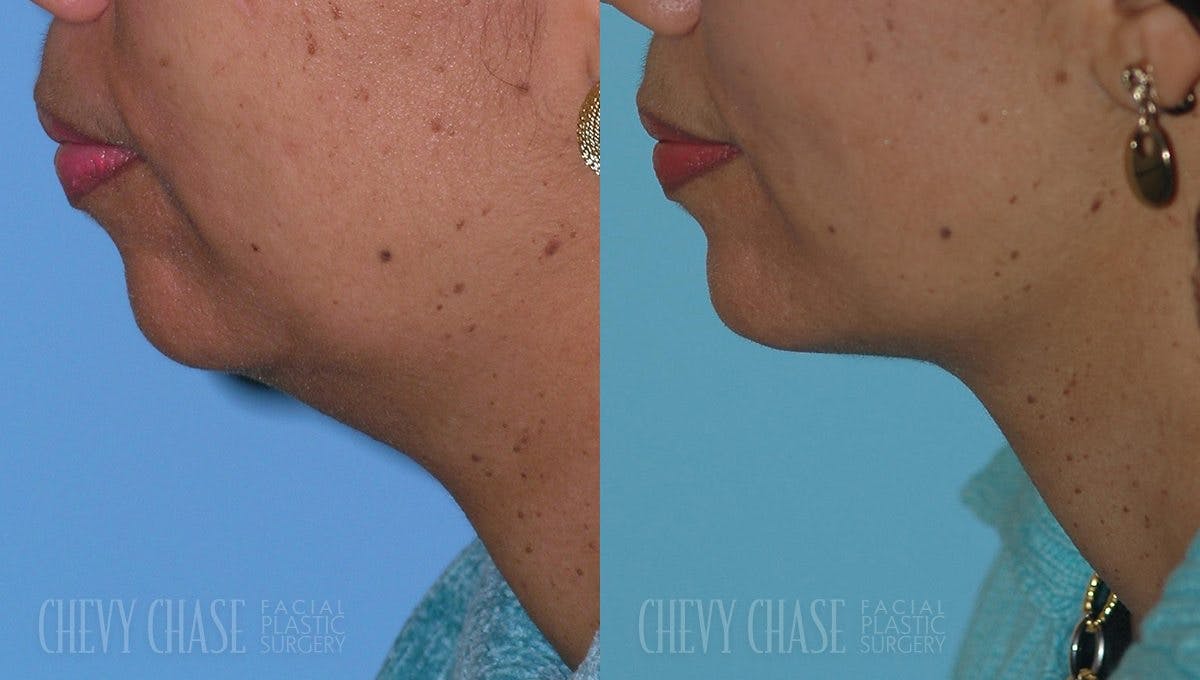Facelift And Necklift Before & After Gallery - Patient 106387572 - Image 2