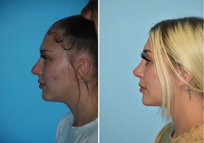 Rhinoplasty Before & After Gallery - Patient 106387574 - Image 1