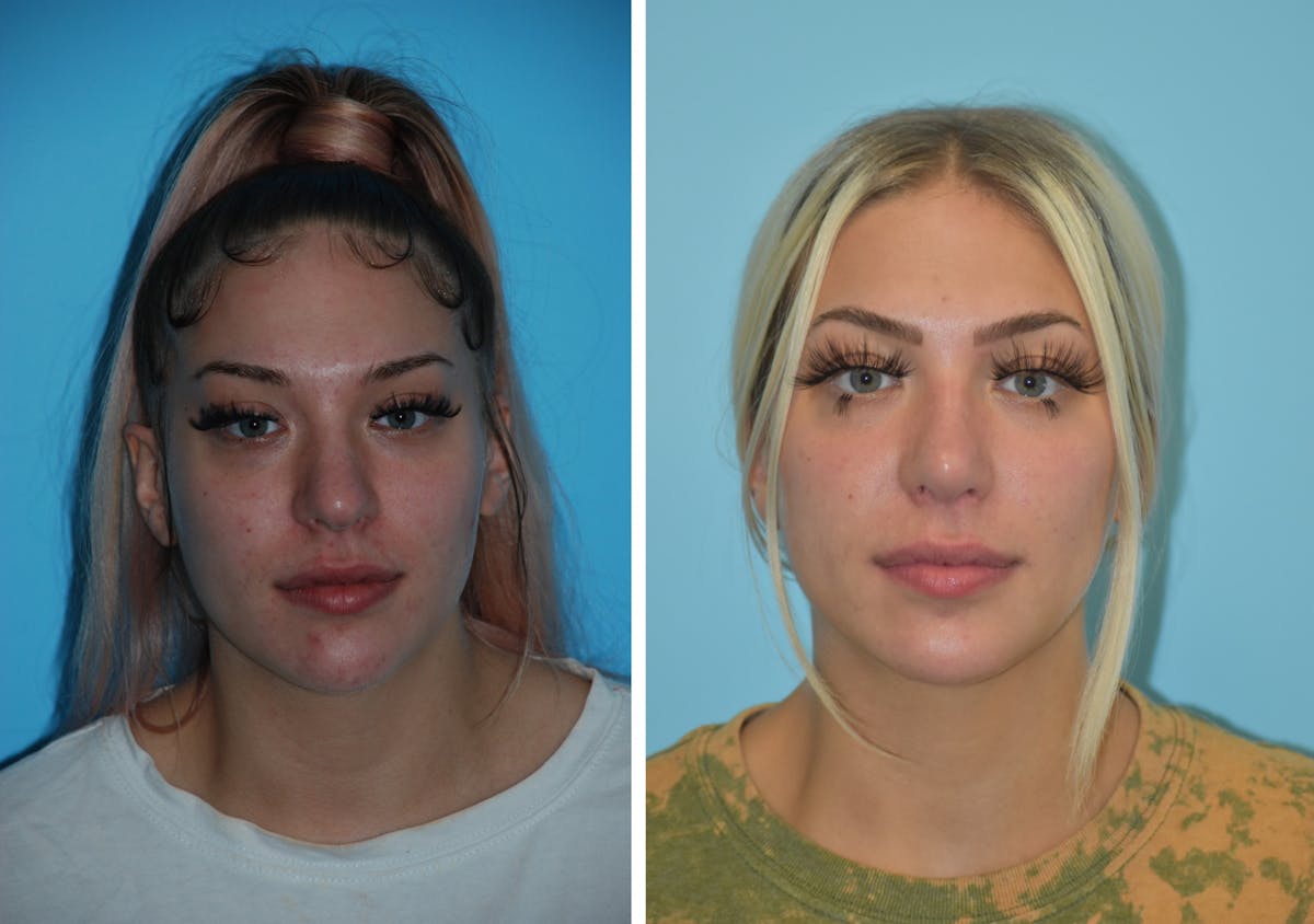 Rhinoplasty Before & After Gallery - Patient 106387574 - Image 2
