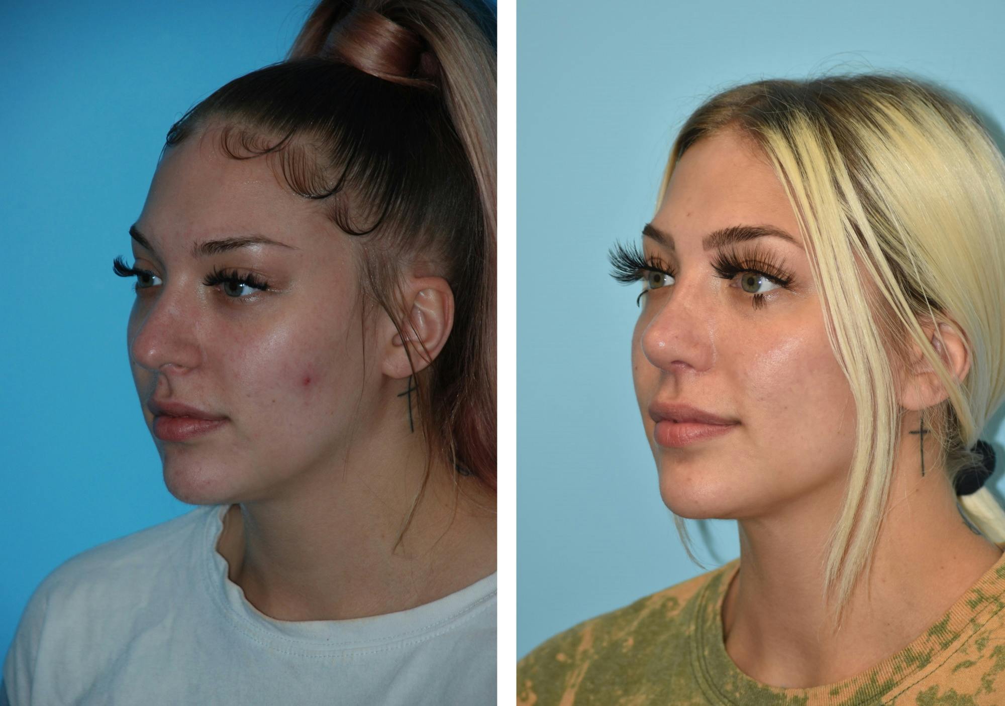 Rhinoplasty Before & After Gallery - Patient 106387574 - Image 3