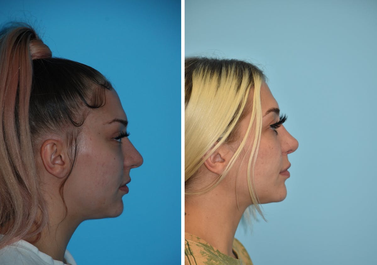Rhinoplasty Before & After Gallery - Patient 106387574 - Image 4