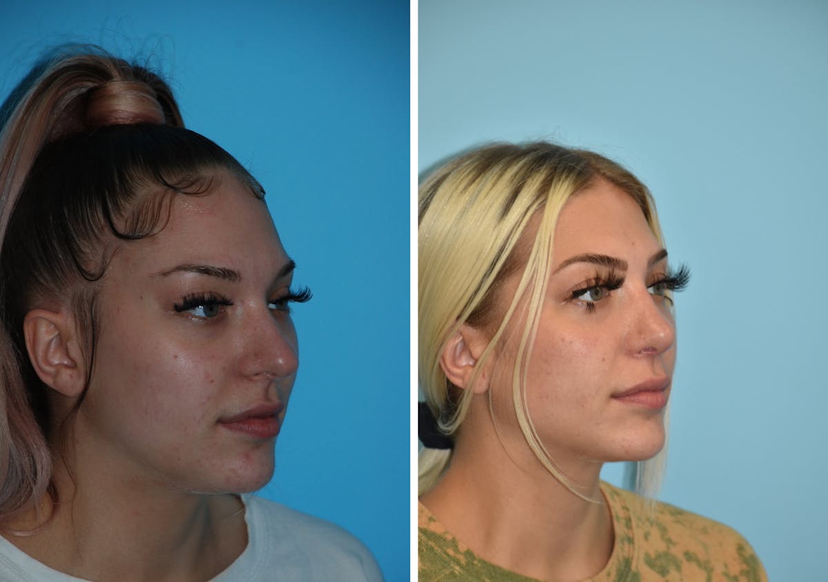 Rhinoplasty Before & After Gallery - Patient 106387574 - Image 5