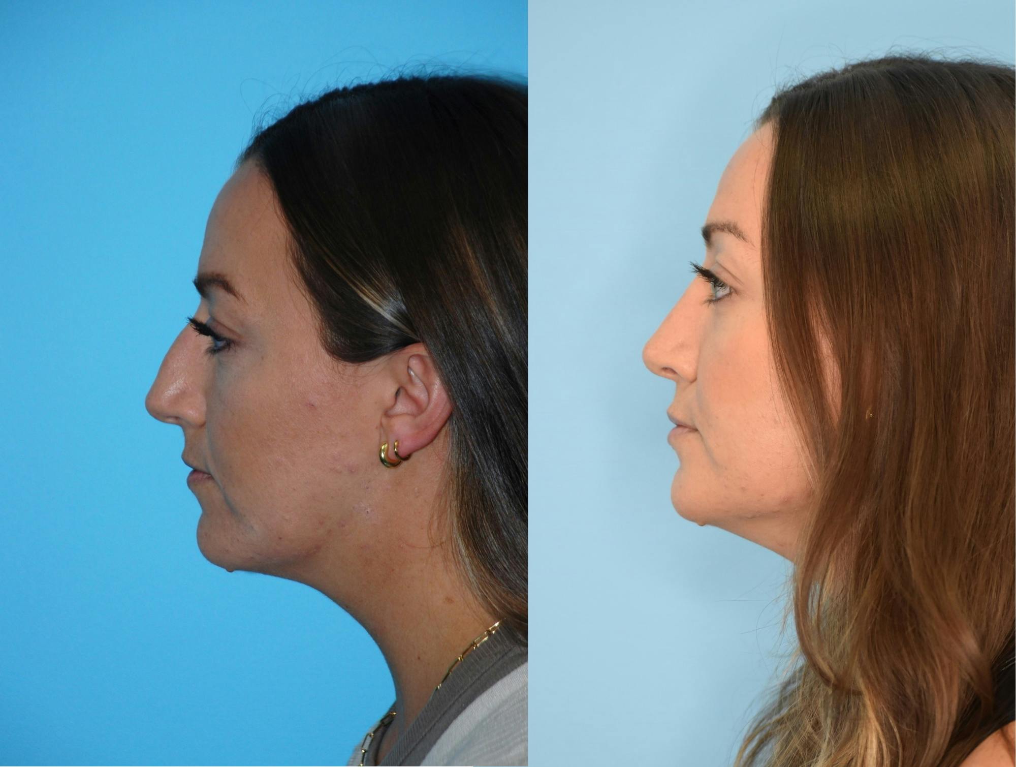 Rhinoplasty Before & After Gallery - Patient 106387611 - Image 1