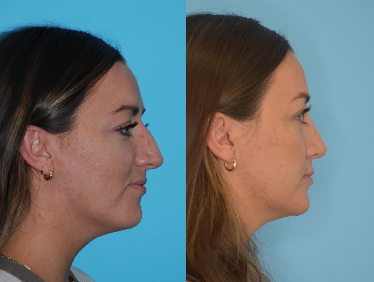 Rhinoplasty Before & After Gallery - Patient 106387611 - Image 3