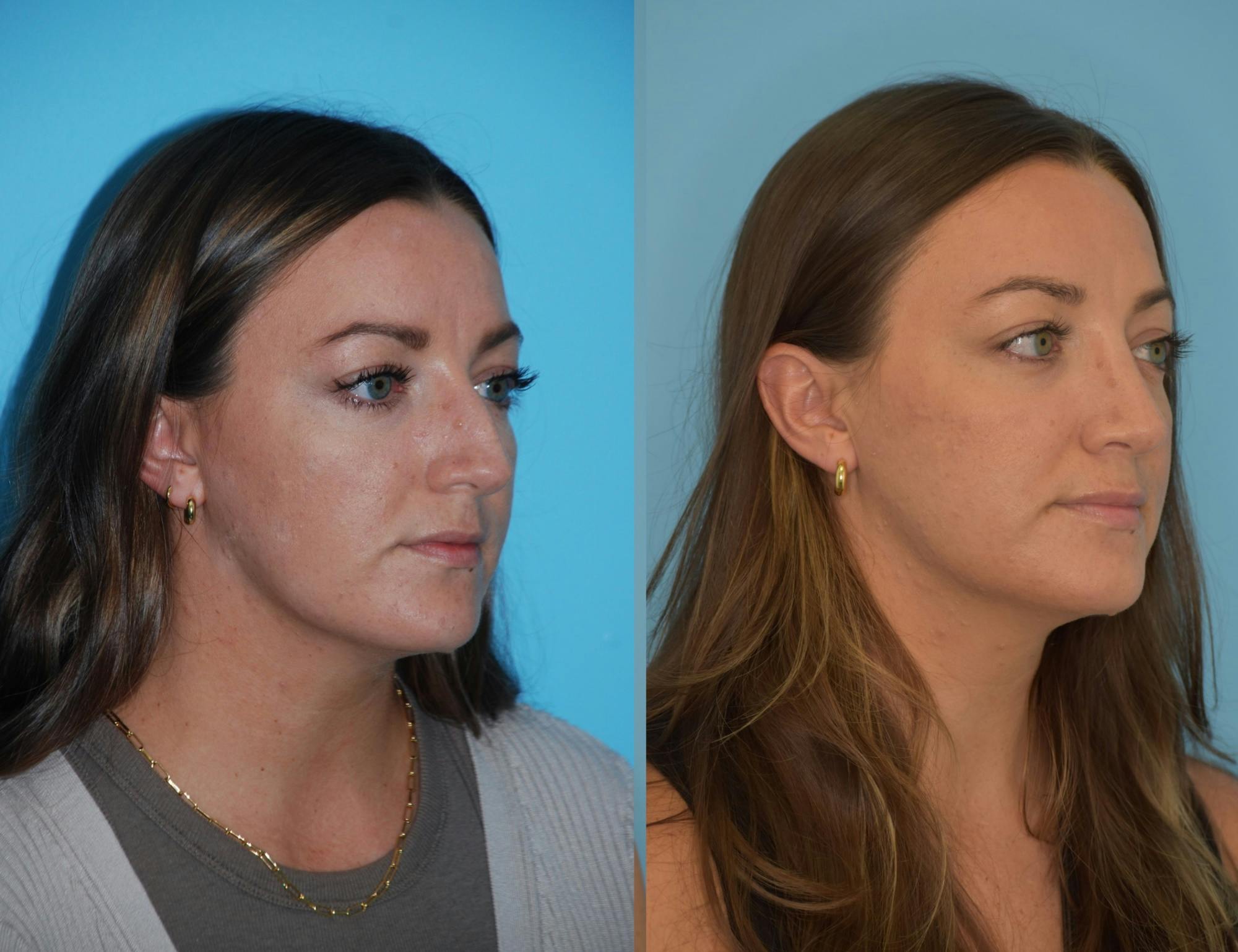 Rhinoplasty Before & After Gallery - Patient 106387611 - Image 4