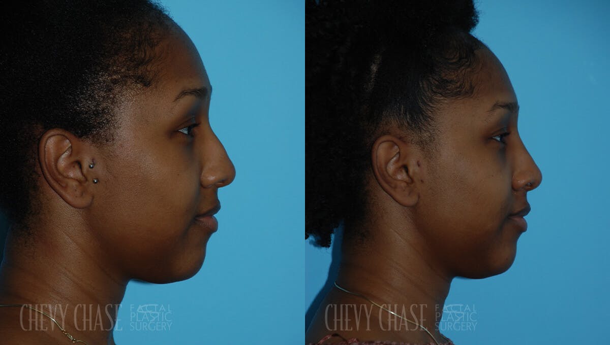 Rhinoplasty Before & After Gallery - Patient 106387619 - Image 1