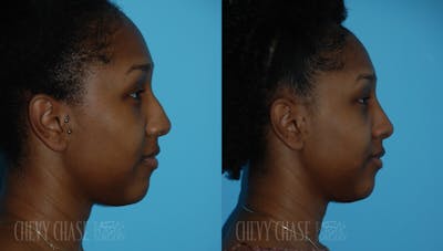 Rhinoplasty Before & After Gallery - Patient 106387619 - Image 1