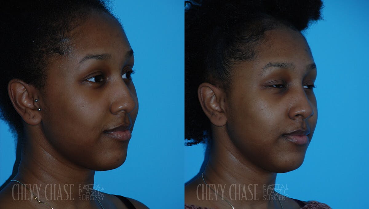 Rhinoplasty Before & After Gallery - Patient 106387619 - Image 2