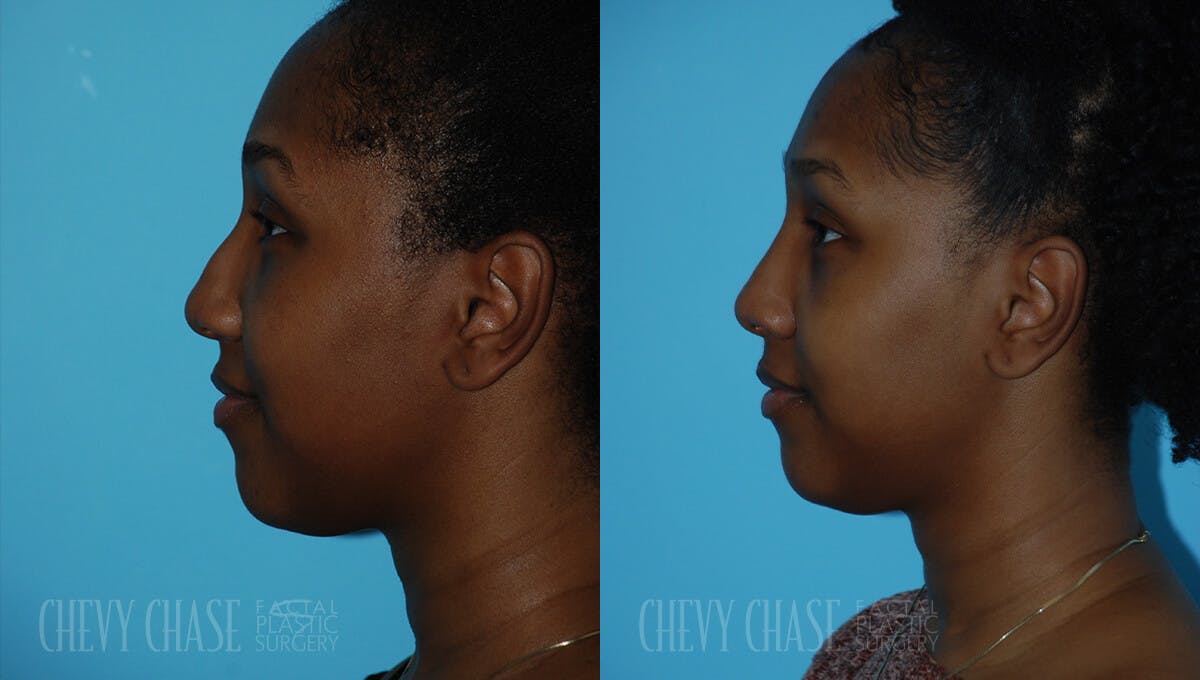 Rhinoplasty Before & After Gallery - Patient 106387619 - Image 3
