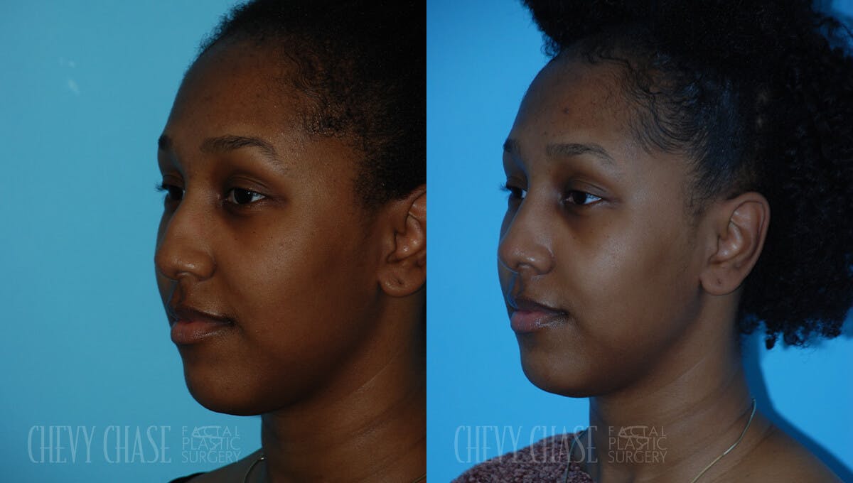 Rhinoplasty Before & After Gallery - Patient 106387619 - Image 4
