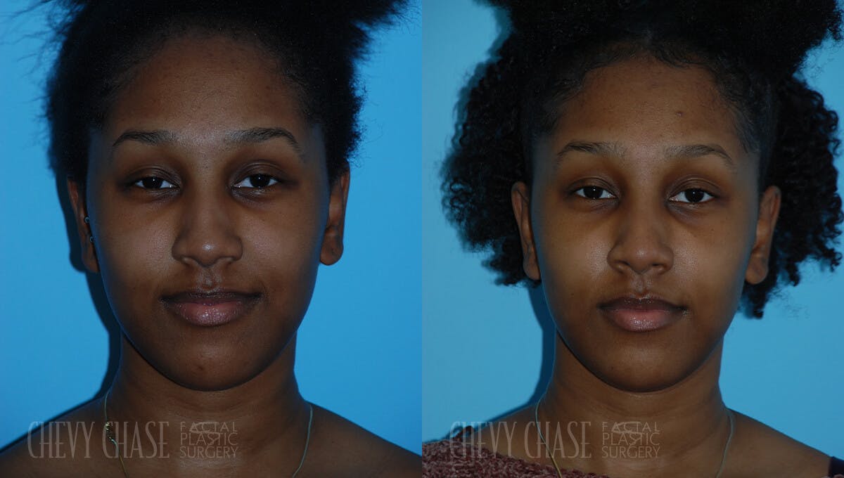 Rhinoplasty Before & After Gallery - Patient 106387619 - Image 6