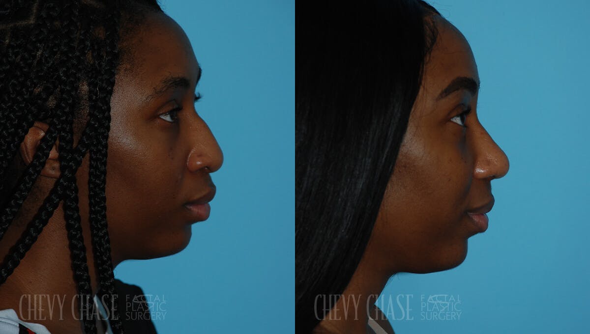 Rhinoplasty Before & After Gallery - Patient 106387621 - Image 1