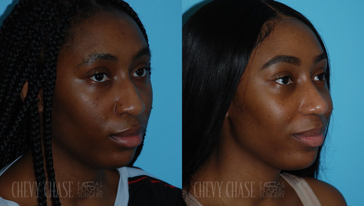 Rhinoplasty Before & After Gallery - Patient 106387621 - Image 2