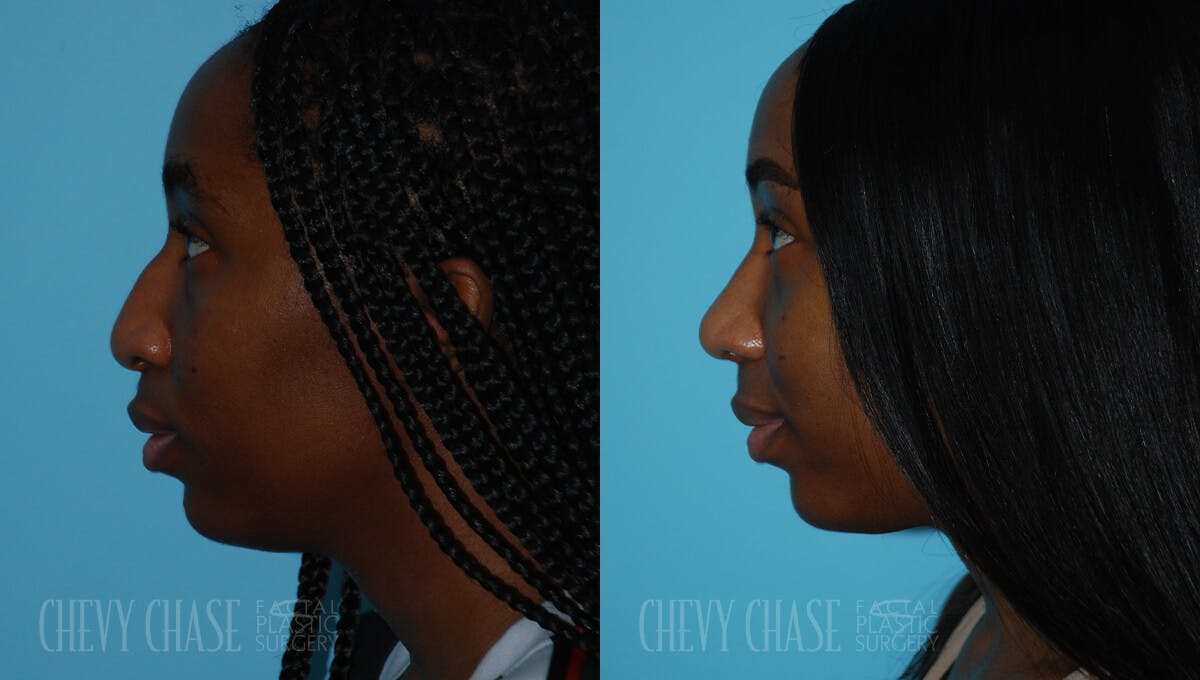 Rhinoplasty Before & After Gallery - Patient 106387621 - Image 3