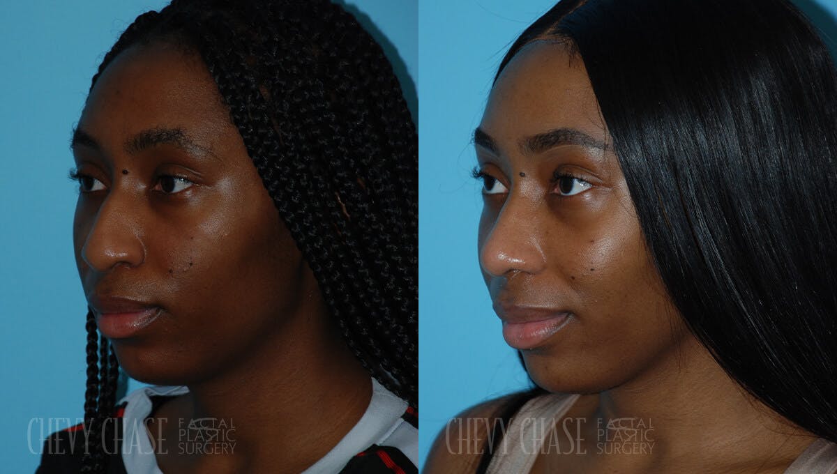 Rhinoplasty Before & After Gallery - Patient 106387621 - Image 4