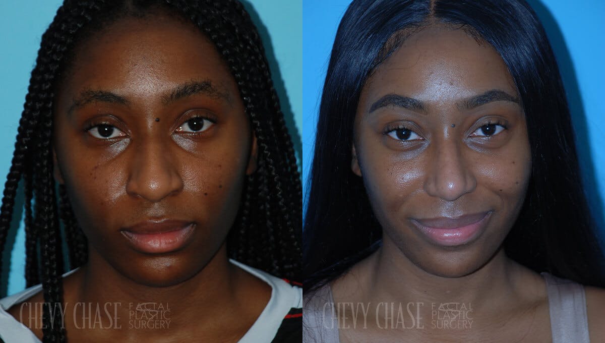 Rhinoplasty Before & After Gallery - Patient 106387621 - Image 5
