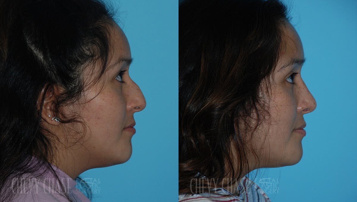 Rhinoplasty Before & After Gallery - Patient 106387622 - Image 1