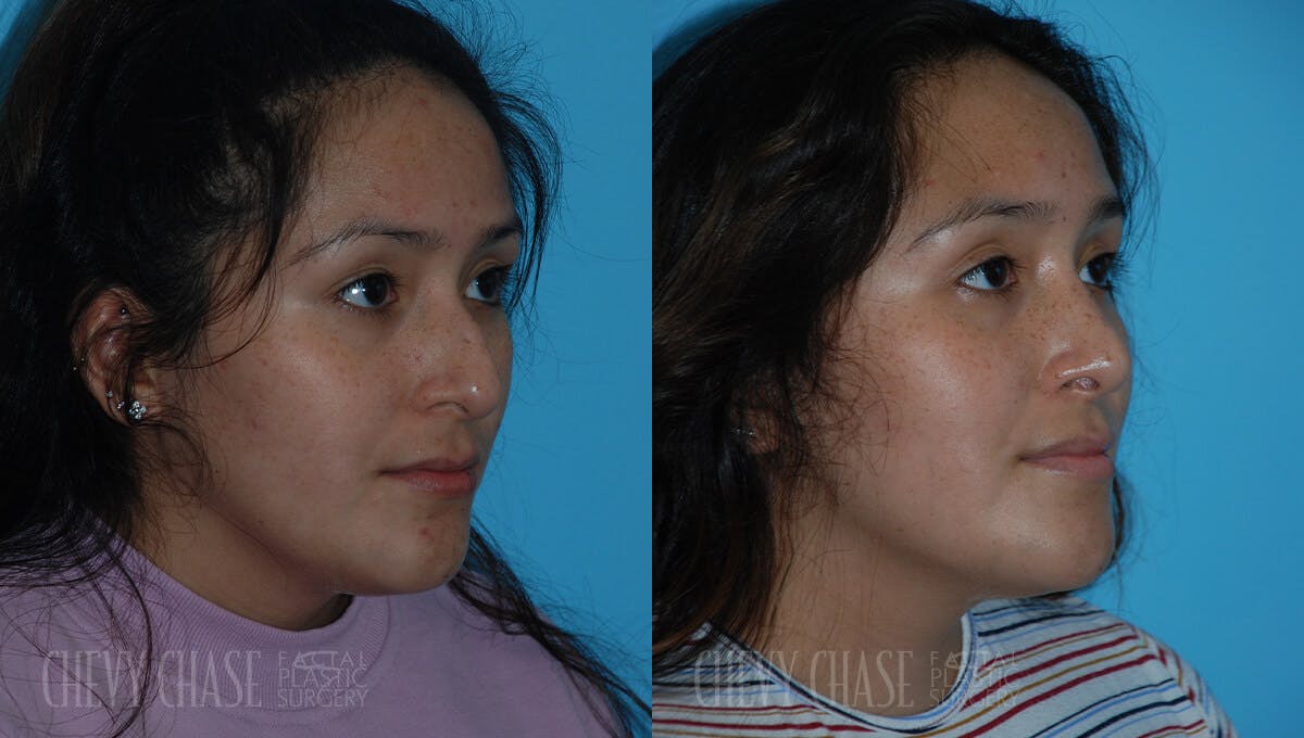 Rhinoplasty Before & After Gallery - Patient 106387622 - Image 2