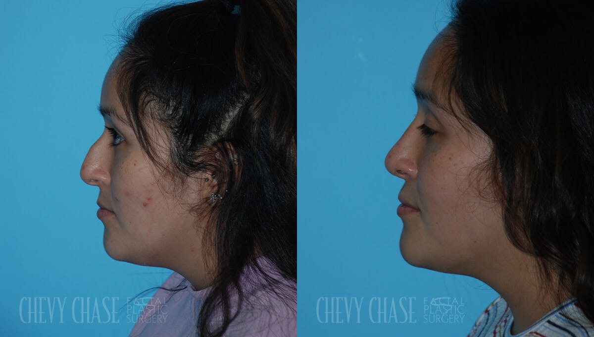 Rhinoplasty Before & After Gallery - Patient 106387622 - Image 3