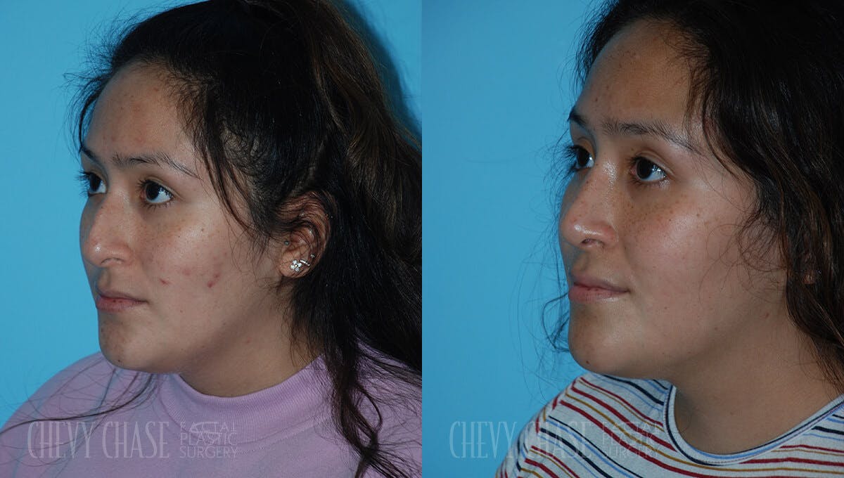 Rhinoplasty Before & After Gallery - Patient 106387622 - Image 4